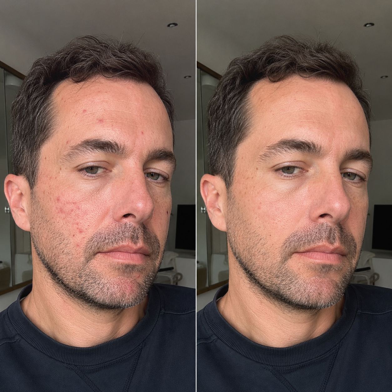 Cicatrici da Acne: Il rituale che Riduce i Segni | Omelia