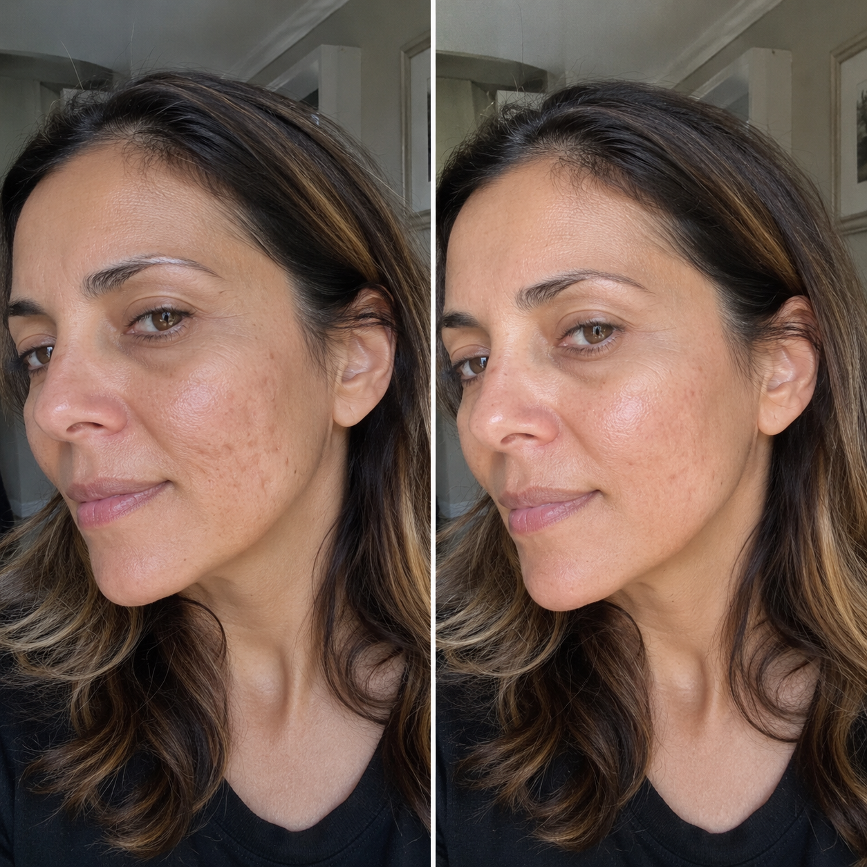 Cicatrici da Acne: Il rituale che Riduce i Segni | Omelia
